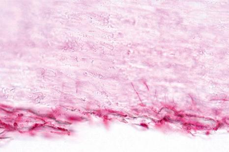 Fig. 23.12, Onychomycosis: an example of mold infection. Note the vertically orientated thin perforating hyphae invading the nail plate.