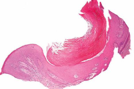 Fig. 23.13, Onychomycosis: this example caused by a dermatophyte infection has resulted in a psoriasiform appearance. Scanning view.