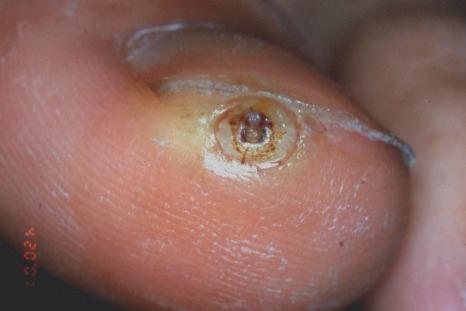 Fig. 23.16, Tungiasis: a typical site. The flea is partially visible.