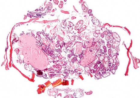 Fig. 23.17, Tungiasis: scanning view showing fragmented tegument and numerous eggs on the right side.