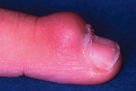 Fig. 23.18, Viral wart: note the white papillary processes just protruding at the proximal nail fold.