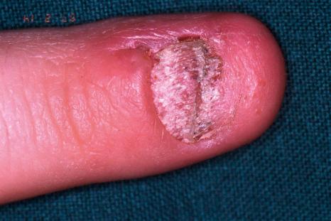 Fig. 23.19, Psoriasis: note the scar from the prior lateral-longitudinal biopsy. The nail plate is dystrophic and thickened.