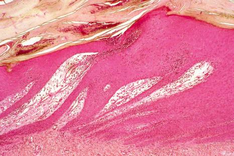 Fig. 23.20, Psoriasis: distal matrix involvement. Note the psoriasiform hyperplasia, neutrophil exocytosis, and subungual hyper- and parakeratosis. There is edema in the superficial dermis with vasodilatation.