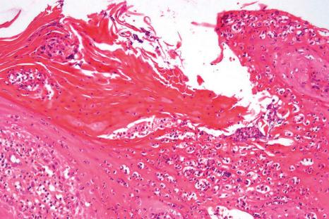 Fig. 23.22, Pustular psoriasis: high-power view showing conspicuous spongiform pustules. Cases such as this should always be examined for the presence of fungi.