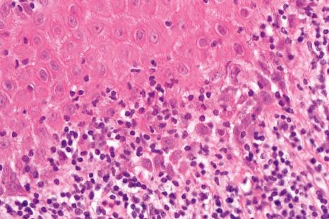 Fig. 23.26, Lichen planus: high-power view showing interface change and lymphocytic infiltration.