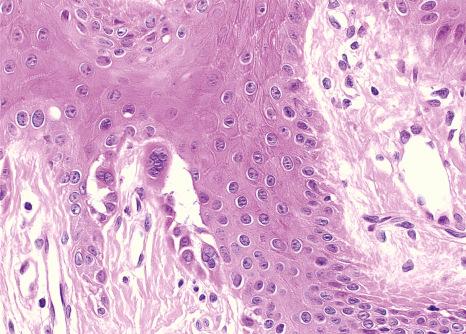 Fig. 23.31, Darier-White disease: suprabasal acantholysis with multinucleated cells.