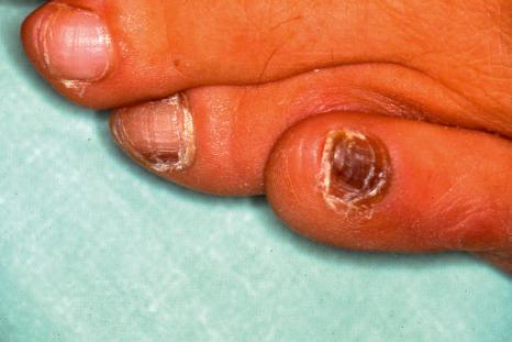 Fig. 23.33, Longitudinal melanonychia: there is involvement of the fourth toenail and complete melanonychia of the fifth toenail. This has resulted from melanocytic activation due to repeated friction from ill-fitting shoes.