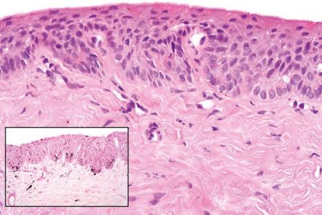 Fig. 23.35, Melanocytic activation: high-power view showing increased pigmentation within the epithelium and melanophages in the dermis (inset: Masson-Fontana stain).