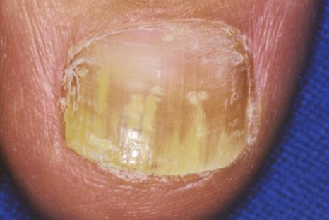 Fig. 23.10, Onychomycosis: this is an example of distal lateral subungual involvement.