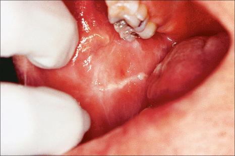 Fig. 11.1, Linea alba on the buccal mucosa: this keratotic linear lesion is caused by friction from teeth and exhibits parakeratosis and keratinocyte edema.