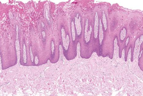 Fig. 11.11, Hereditary benign intraepithelial dyskeratosis: there is parakeratosis, dyskeratosis, and acanthosis.