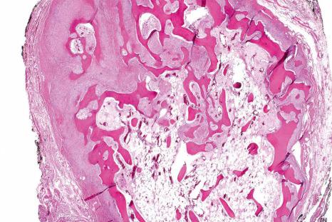 Fig. 11.13, Osseous choristoma from the tongue: there is a discrete nodule of bone and fatty tissue.