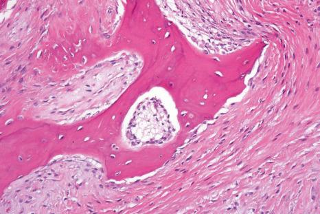 Fig. 11.14, Osseous choristoma from the tongue: the woven bone exhibits focal osteoblastic rimming and is deposited by the surrounding mesenchymal spindle cells.