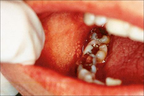 Fig. 11.15, Fordyce granules: typical yellow papules of the buccal mucosa.