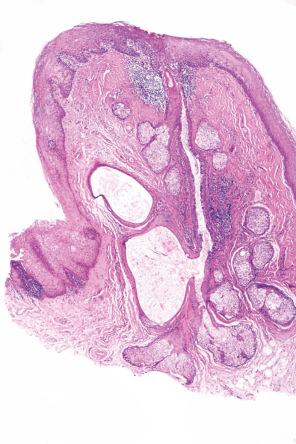 Fig. 11.16, Sebaceous hyperplasia: numerous lobules of sebaceous glands empty into a central dilated duct.