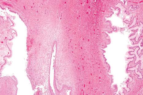 Fig. 11.17, Heterotopic gastrointestinal tissue: cystic structures are lined by squamous epithelium and colonic-type epithelium.