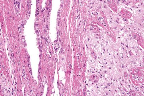 Fig. 11.18, Heterotopic brain tissue: note the presence of glial and ependymal tissue.