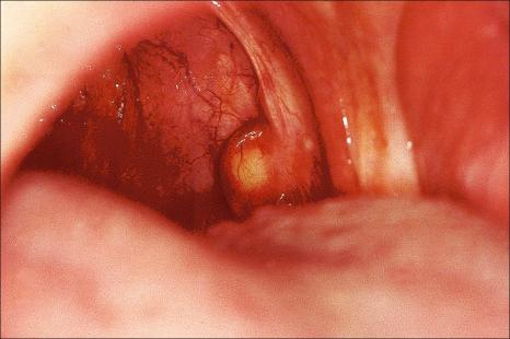 Fig. 11.19, Oral lymphoepithelial cyst: note the yellow nodule located behind the anterior faucial pillar.