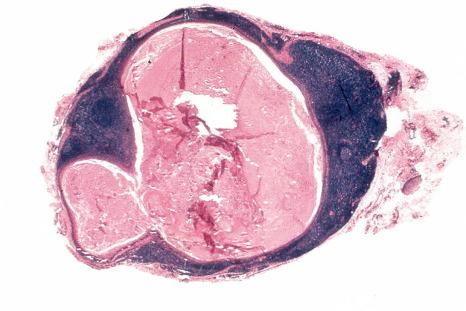 Fig. 11.20, Oral lymphoepithelial cyst: the cyst is filled with keratin debris and completely encircled by lymphoid tissue.