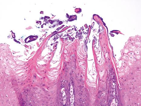 Fig. 11.2, Normal tongue dorsum: there are four ovoid fungiform papillae and many filiform papillae on the left of field also (inset) composed of spires of parakeratin associated with bacterial colonies.