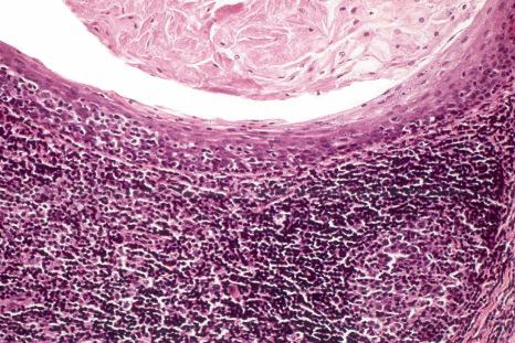 Fig. 11.21, Oral lymphoepithelial cyst: there is lymphocyte exocytosis through the reticulated lymphoepithelium and a small germinal center is present.