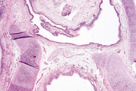 Fig. 11.22, Dermoid tumor: note the presence of cartilage and cystic spaces lined by intestinal-type epithelium.