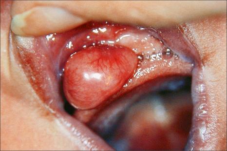 Fig. 11.23, Congenital granular cell tumor: there is a firm nodule on the maxillary alveolar ridge mucosa, which is a typical location for this tumor.