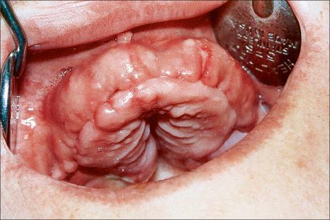 Fig. 11.25, Hereditary gingival fibromatosis: there is extensive overgrowth of dense fibrous tissue in the maxillary mucosa.