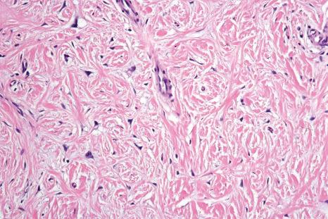 Fig. 11.27, Hereditary gingival fibromatosis: plump, stellate-shaped fibroblasts are seen in a densely collagenous stroma.