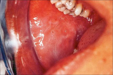 Fig. 11.29, Leukoedema: the buccal mucosa has a pale, milky white appearance.