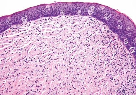 Fig. 11.3, Subgemmal neurogenous plaque: this is a neural plexus located beneath taste buds and commonly seen on the posterior lateral tongue.