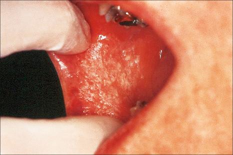 Fig. 11.32, Morsicatio mucosae oris (chronic bite/factitial keratosis): there are rough, shaggy, poorly demarcated papules and plaques on the buccal mucosa.