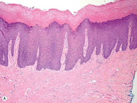 Fig. 11.36, Benign ridge keratosis: ( A ) there is hyperkeratosis, wedge-shaped hypergranulosis, slight papillary acanthosis, tapered rete ridges, and minimal to no inflammation; ( B ) there is no evidence of cytological atypia.