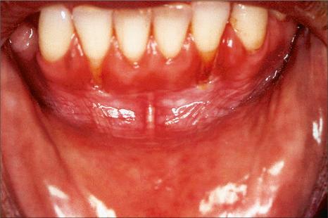 Fig. 11.37, Smokeless tobacco keratosis: note the gray white, pale, wrinkled mandibular vestibular mucosa.