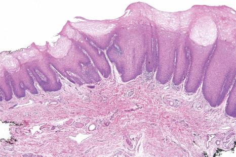 Fig. 11.38, Smokeless tobacco lesion: the superficial edematous keratinocytes are sharply demarcated from the underlying acanthotic epithelium, and there are parakeratin chevrons.