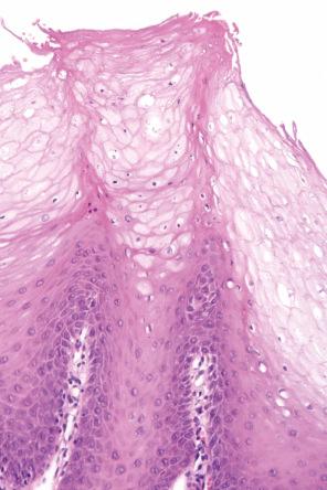 Fig. 11.39, Smokeless tobacco lesion: note the parakeratin chevrons and anucleate and edematous superficial keratinocytes with pyknotic nuclei.