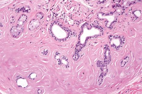 Fig. 11.40, Smokeless tobacco lesion: eosinophilic amyloid-like material is often seen within underlying salivary gland parenchyma.