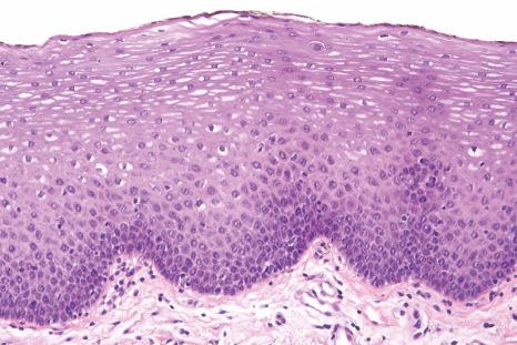 Fig. 11.4, Normal buccal mucosa: the epithelium is nonkeratinized and is 15–25 cells thick.