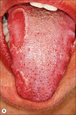 Fig. 11.41, Benign migratory glossitis: ( A ) note the erythematous depapillated area with a white rim; ( B ) more extensive involvement of the tongue which is fissured.