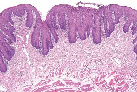 Fig. 11.42, Benign migratory glossitis: note the absence of filiform papillae (filiform papillary atrophy) and psoriasiform epithelial hyperplasia.