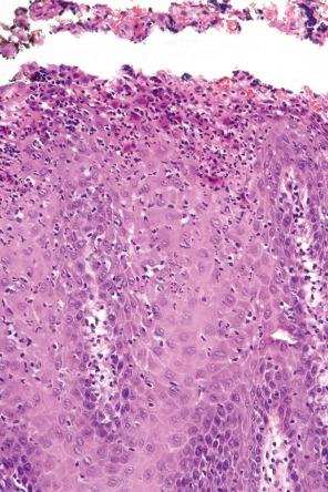 Fig. 11.43, Benign migratory glossitis: many spongiotic pustules are present and there is neutrophilic exocytosis.