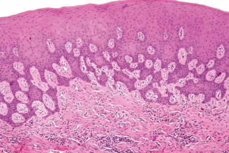 Fig. 11.44, Foreign body gingivitis: there is non-specific mild chronic inflammation in the lamina propria.