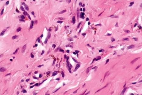 Fig. 11.45, Foreign body gingivitis: small granules of foreign material that are refractile in polarized light are present.