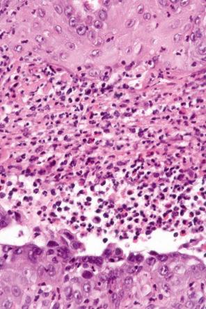 Fig. 11.48, Pyostomatitis vegetans: there is acantholysis and many neutrophils and eosinophils are present suprabasally.