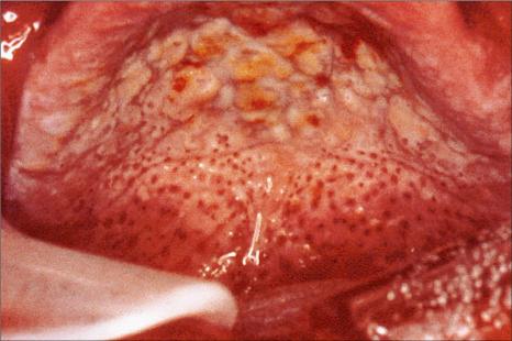 Fig. 11.49, Nicotinic stomatitis: note the cobblestone, multinodular appearance of the hard palatal mucosa, with interspersed red puncta, in a patient who reverse smokes.