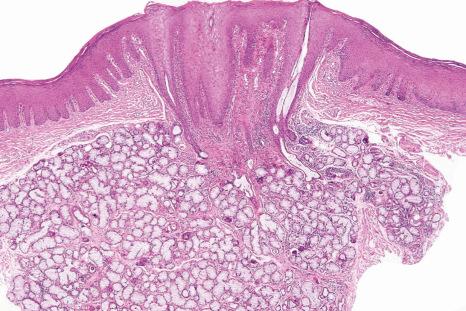 Fig. 11.50, Nicotinic stomatitis: each nodule consists of metaplastic excretory salivary ducts and surrounding chronic inflammation; there is hyperkeratosis.