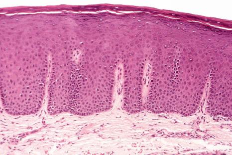 Fig. 11.5, Normal palatal mucosa: the palatal mucosa and gingiva both are thinly orthokeratinized. The dense fibrous tissue in the lamina propria is normal for these sites.