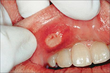 Fig. 11.52, Recurrent aphthous ulcer: a typical aphthous ulcer covered by yellow fibrin membrane with surrounding erythema on the upper lip mucosa.