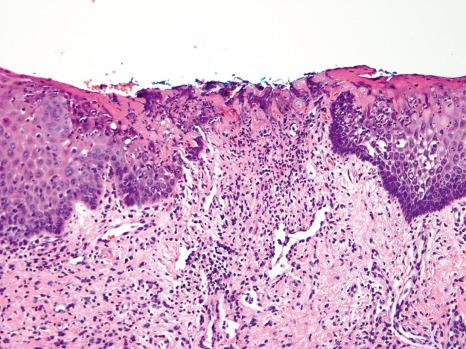 Fig. 11.53, Recurrent aphthous ulcer: there is a fibrin membrane with underlying acute and chronic inflammation and vascular ectasia; the adjacent epithelium exhibits spongiotic pustules and intraepithelial hemorrhage.