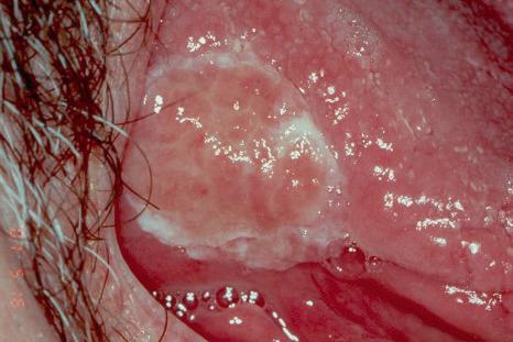 Fig. 11.54, Traumatic ulcerative granuloma: this indurated ulcer had developed after a tongue biopsy at that site.